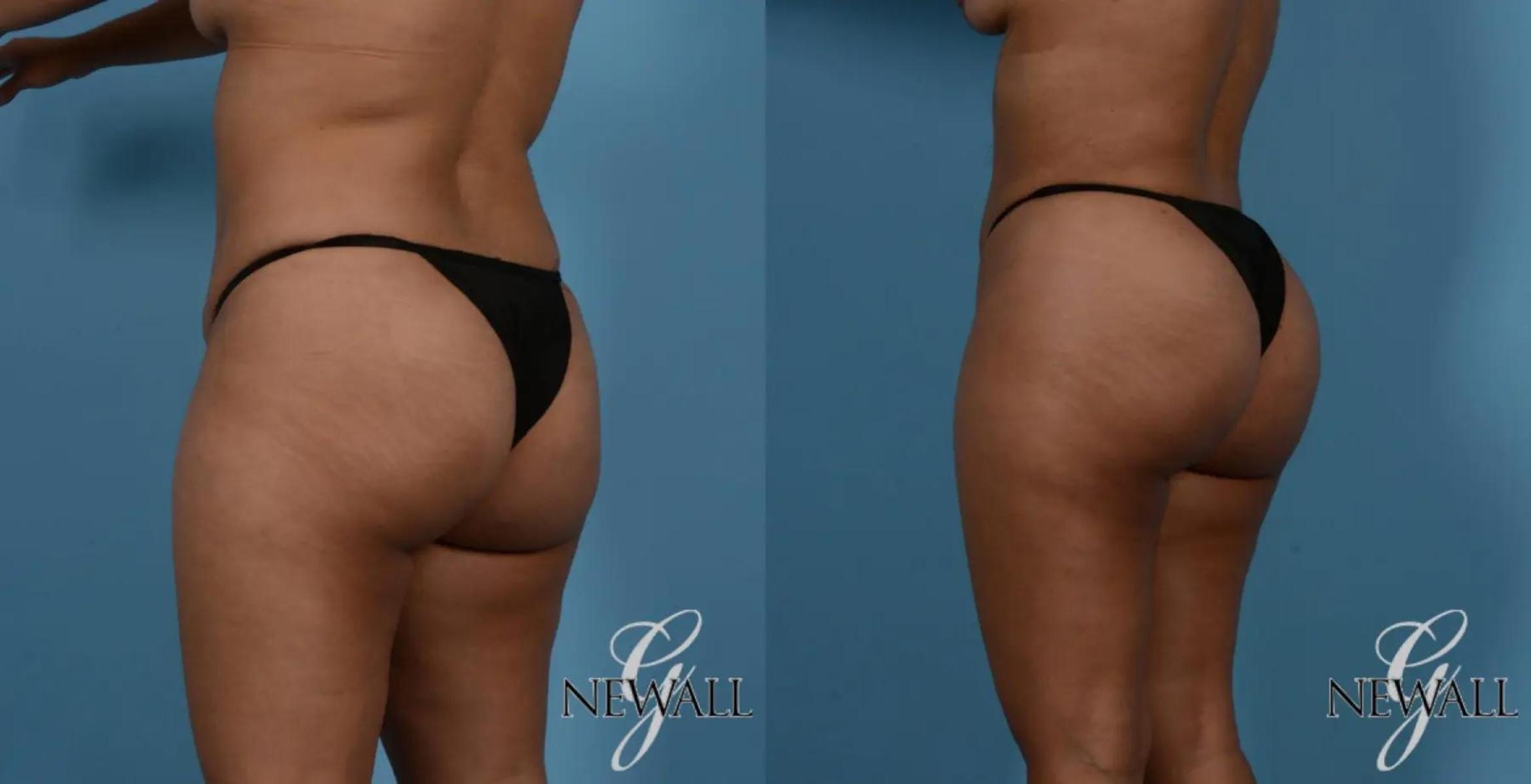 Before & After Brazilian Butt Lift Case 16982 View 2 View in Houston, TX