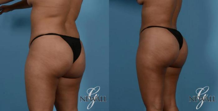 Before & After Brazilian Butt Lift Case 16982 View 2 View in Houston, TX
