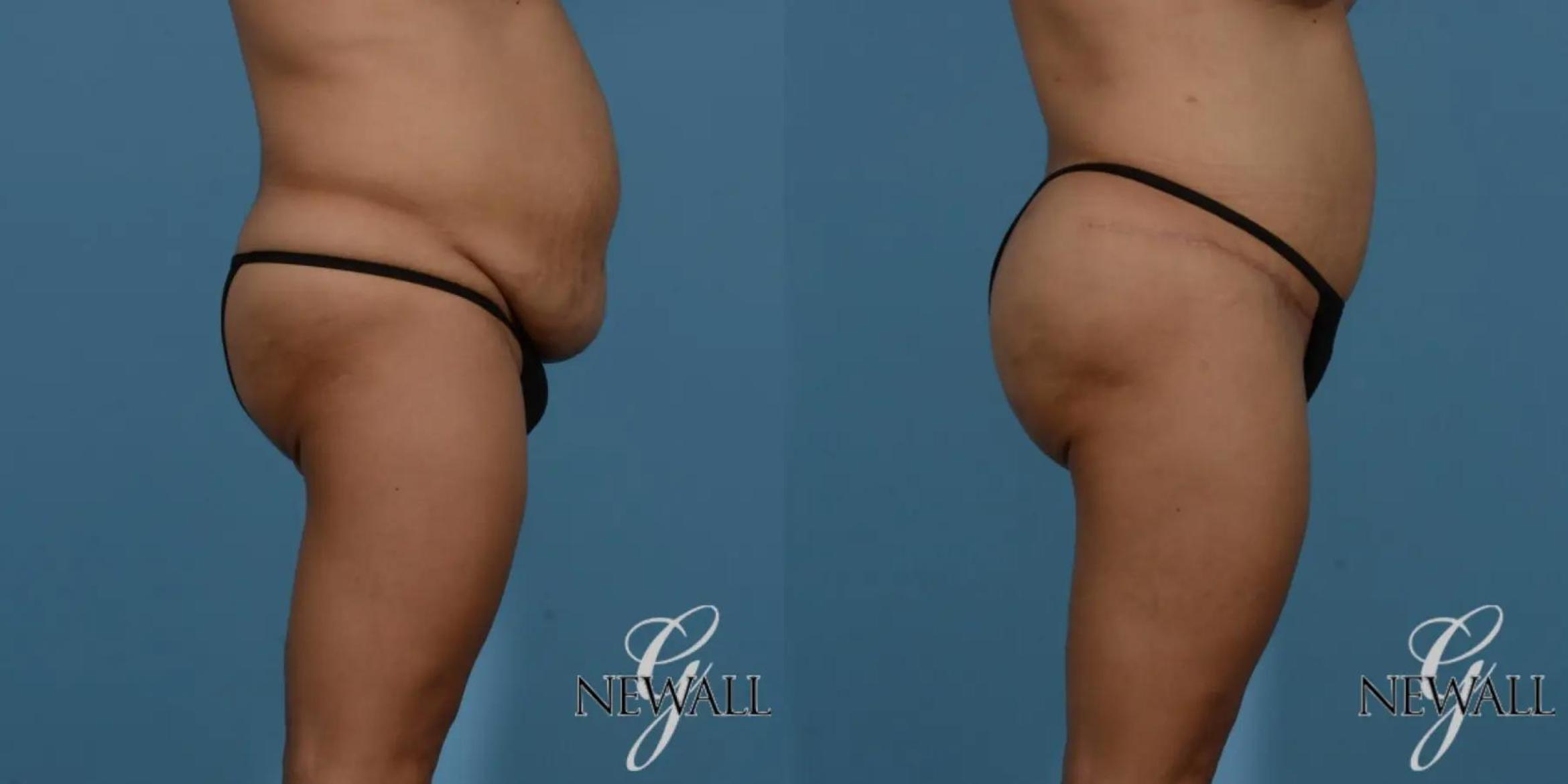 Before & After Brazilian Butt Lift Case 16988 View 2 View in Houston, TX