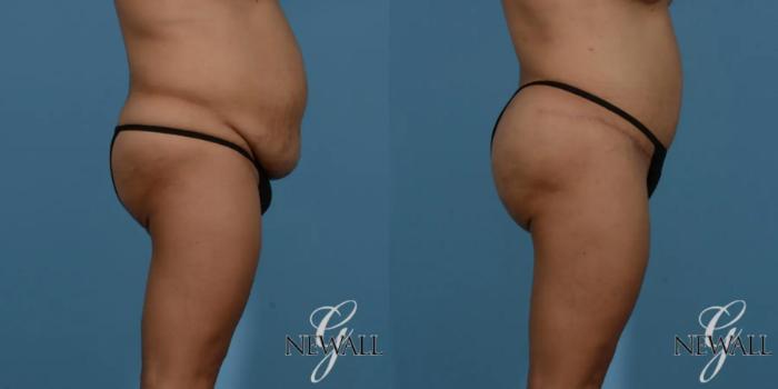 Before & After Brazilian Butt Lift Case 16988 View 2 View in Houston, TX