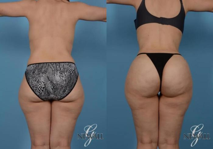 Before & After Brazilian Butt Lift Case 16997 View 1 View in Houston, TX