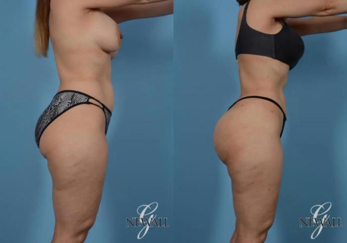 Before & After Brazilian Butt Lift Case 16997 View 2 View in Houston, TX
