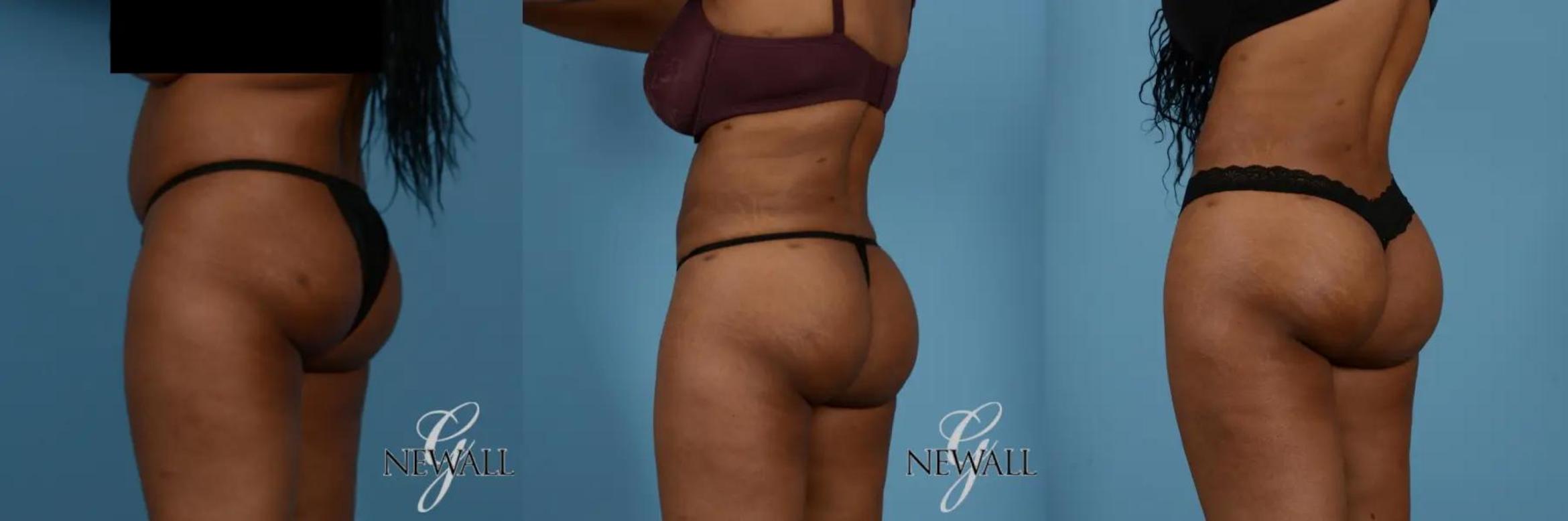 Before & After Brazilian Butt Lift Case 17018 View 2 View in Houston, TX