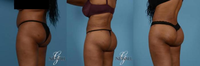 Before & After Brazilian Butt Lift Case 17018 View 2 View in Houston, TX