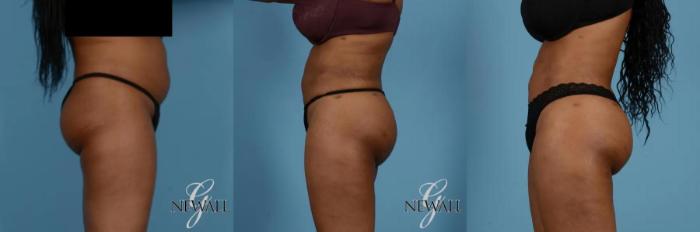 Before & After Brazilian Butt Lift Case 17018 View 3 View in Houston, TX