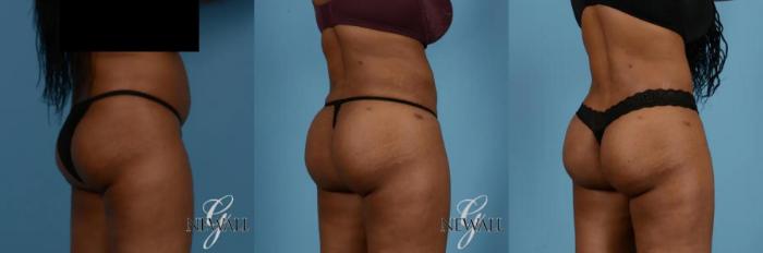 Before & After Brazilian Butt Lift Case 17018 View 4 View in Houston, TX