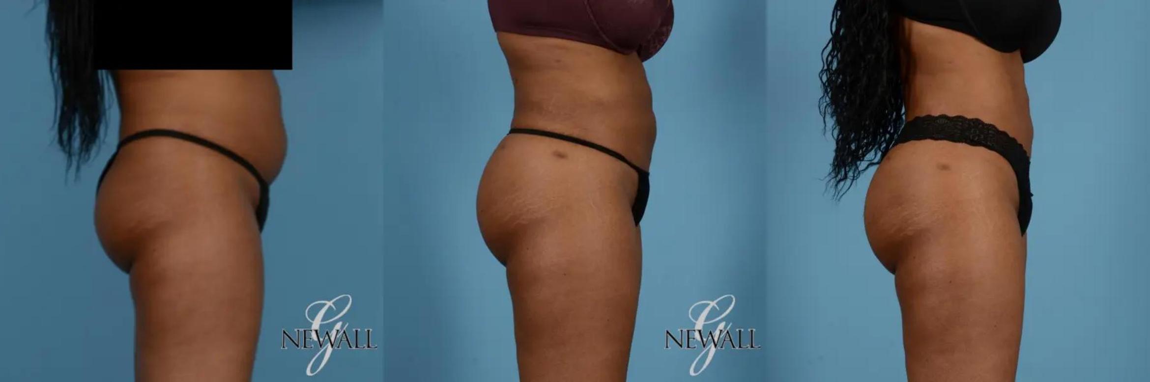 Before & After Brazilian Butt Lift Case 17018 View 5 View in Houston, TX