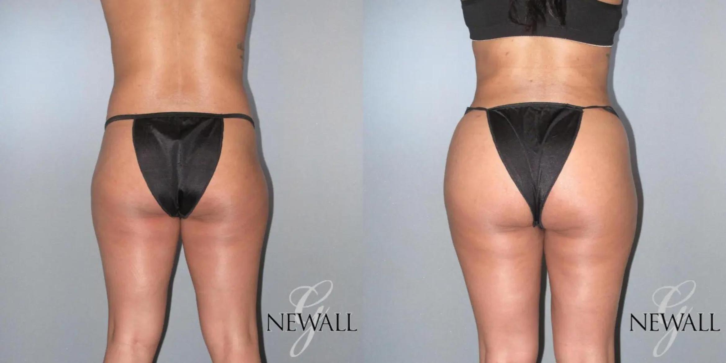 Before & After Brazilian Butt Lift Case 17027 View 2 View in Houston, TX
