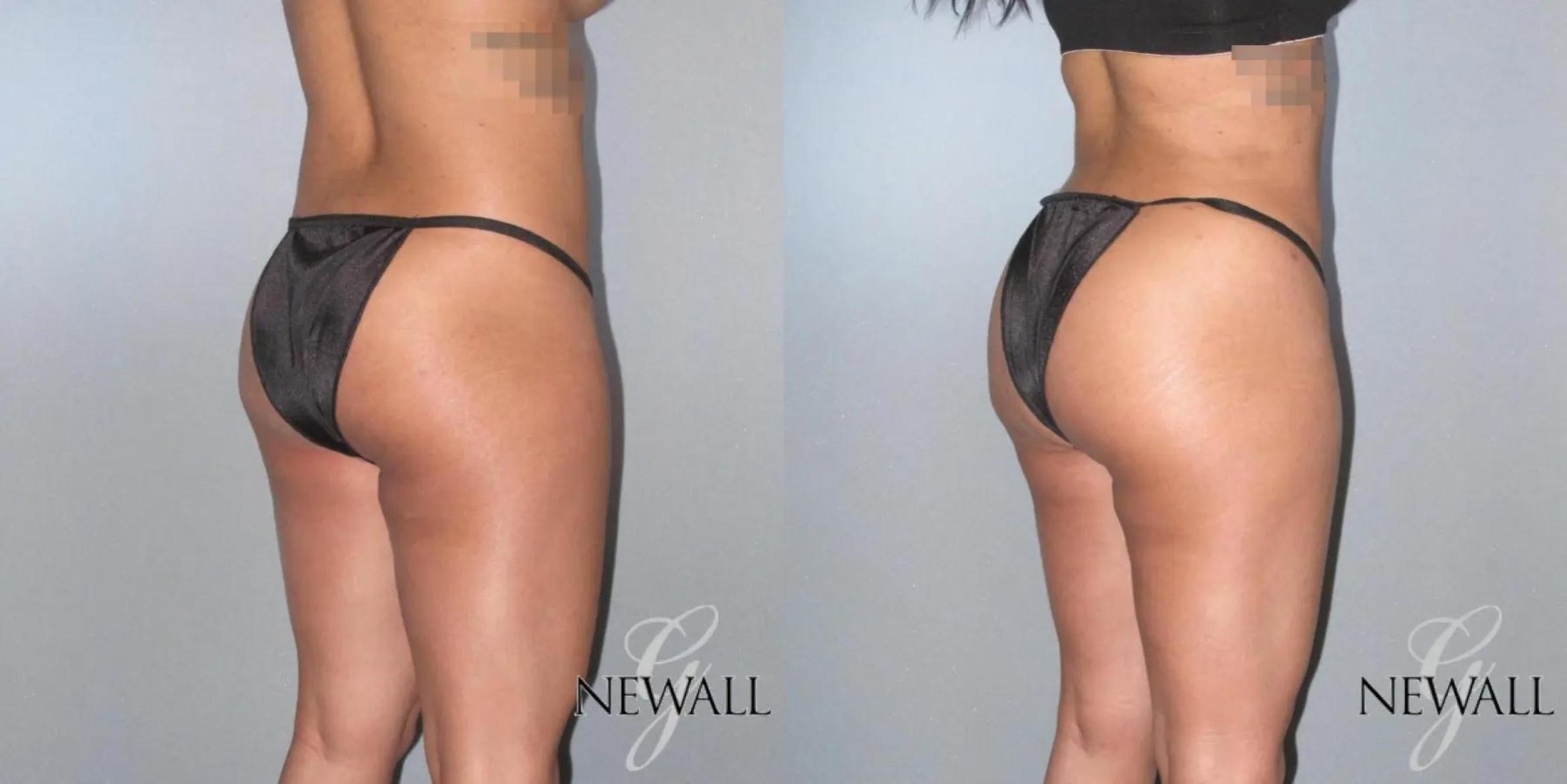 Before & After Brazilian Butt Lift Case 17027 View 3 View in Houston, TX
