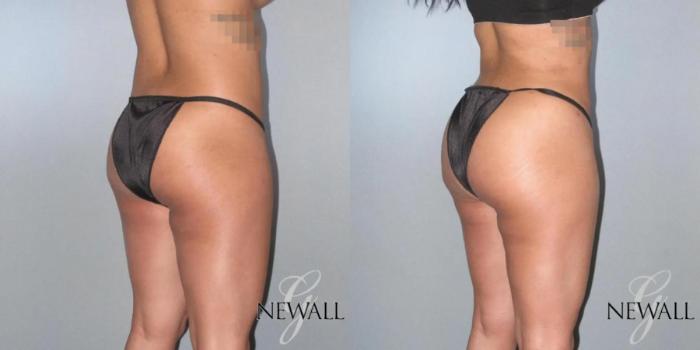 Before & After Brazilian Butt Lift Case 17027 View 3 View in Houston, TX