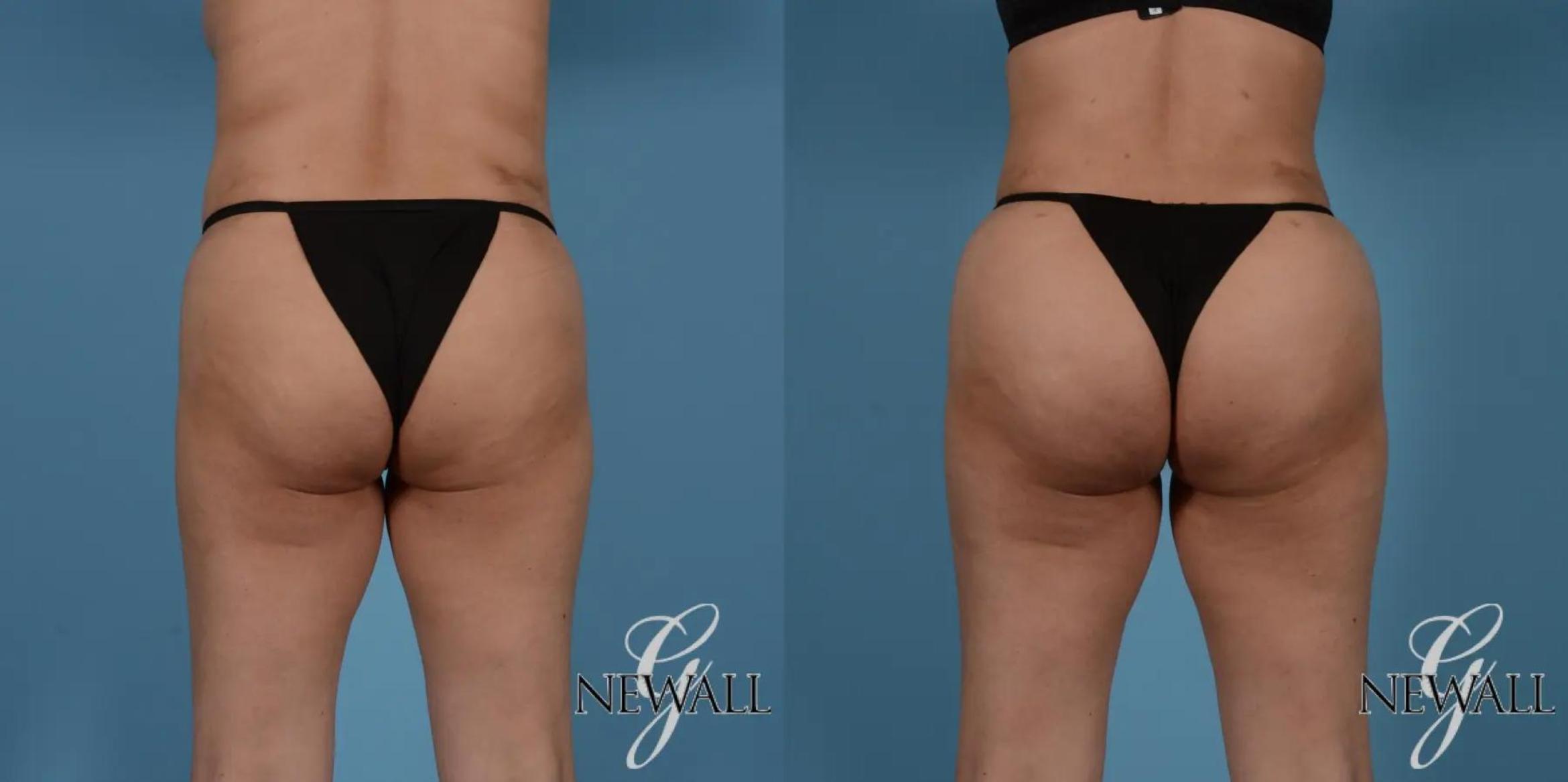 Before & After Brazilian Butt Lift Case 17525 View 1 View in Houston, TX