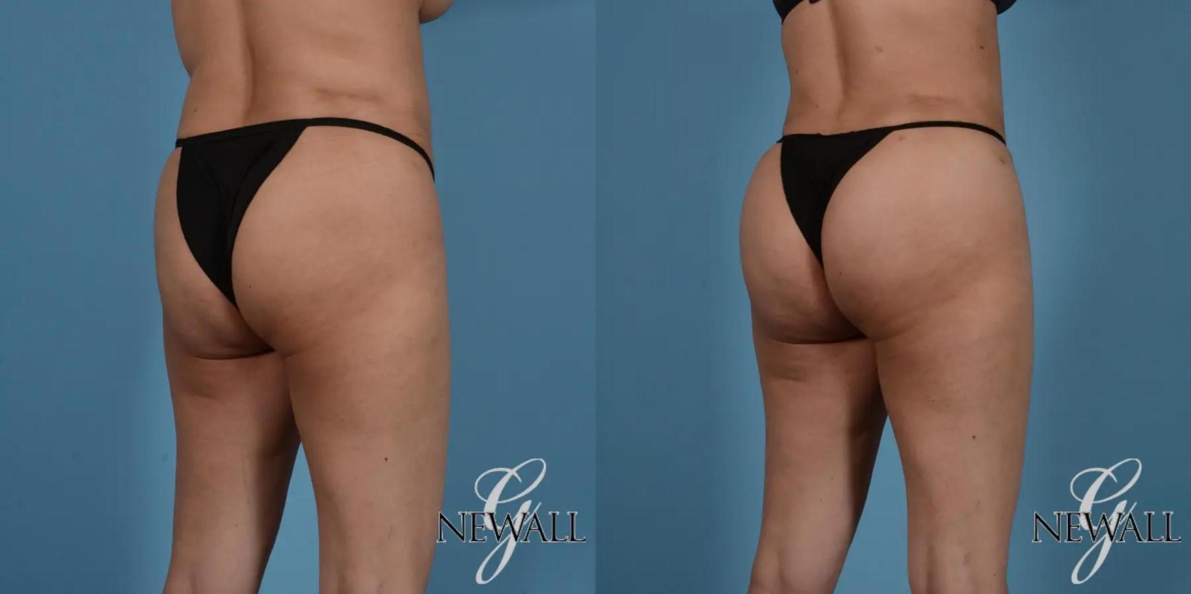 Before & After Brazilian Butt Lift Case 17525 View 2 View in Houston, TX