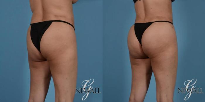 Before & After Brazilian Butt Lift Case 17525 View 2 View in Houston, TX