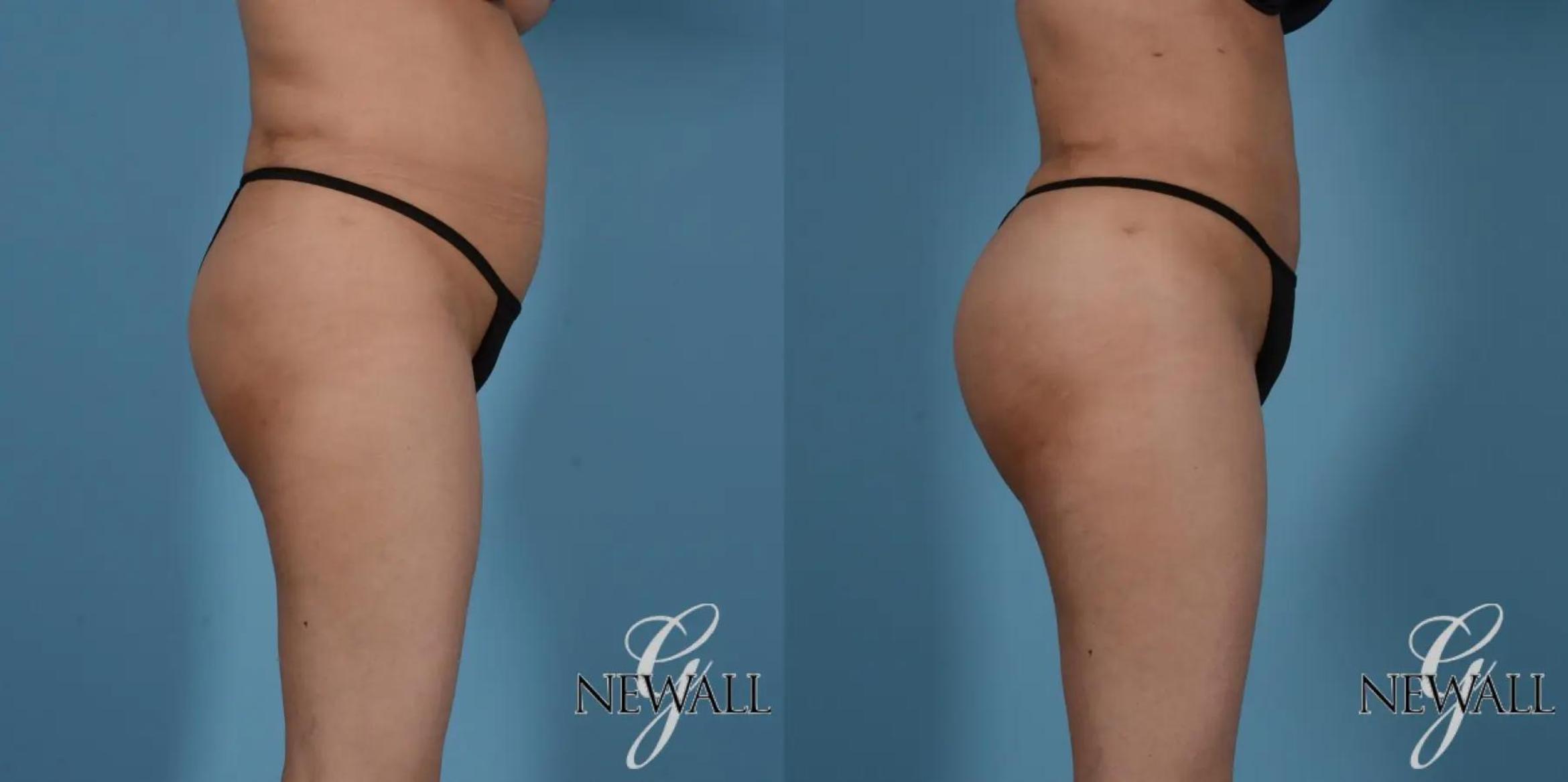 Before & After Brazilian Butt Lift Case 17525 View 3 View in Houston, TX