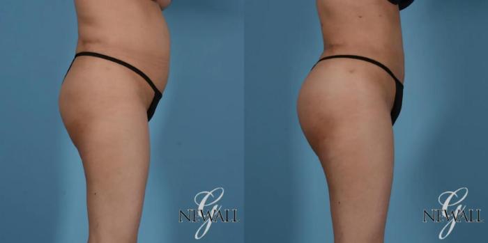 Before & After Brazilian Butt Lift Case 17525 View 3 View in Houston, TX
