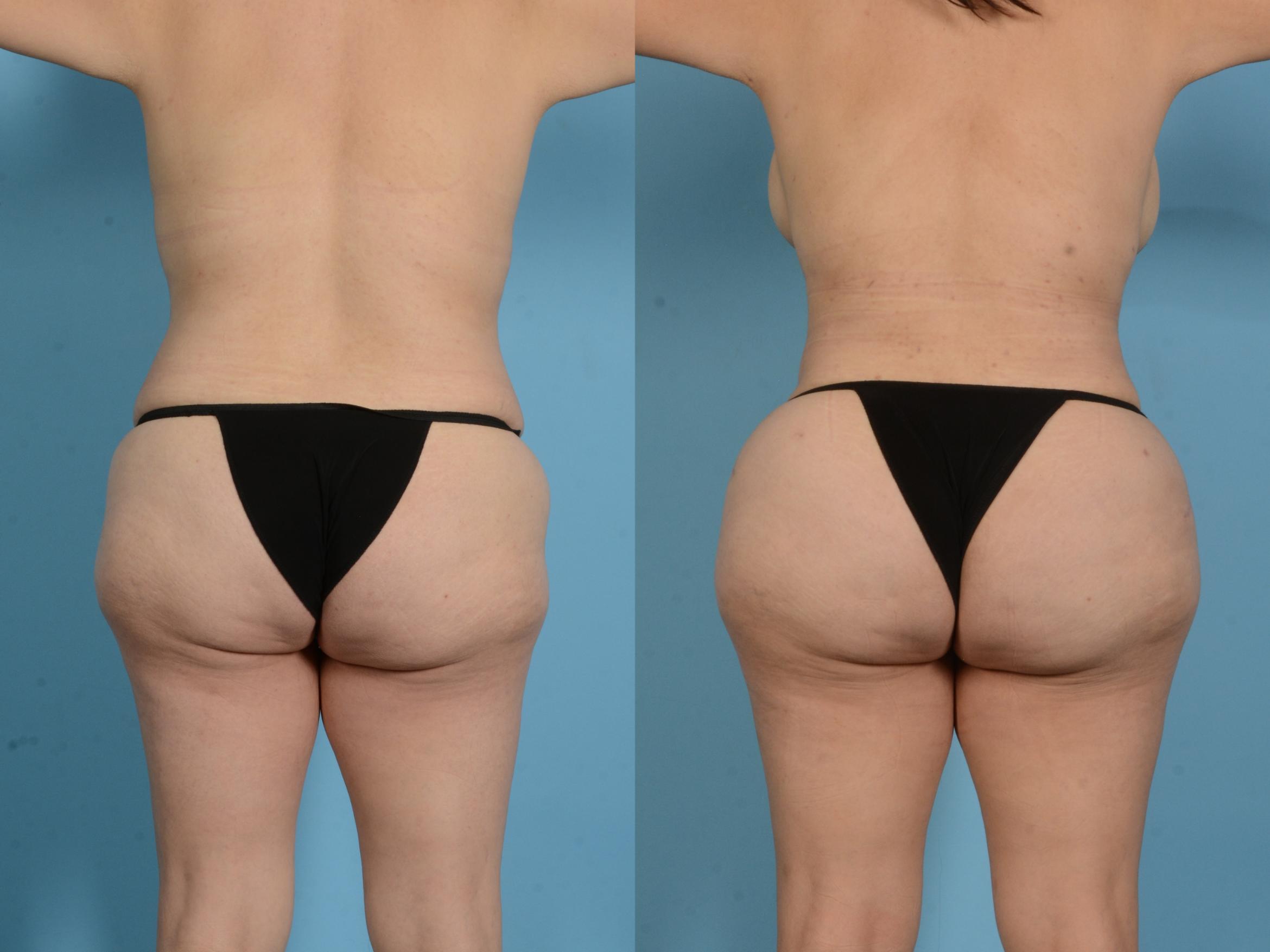 Before & After Brazilian Butt Lift Case 18138 Back View in Houston, TX