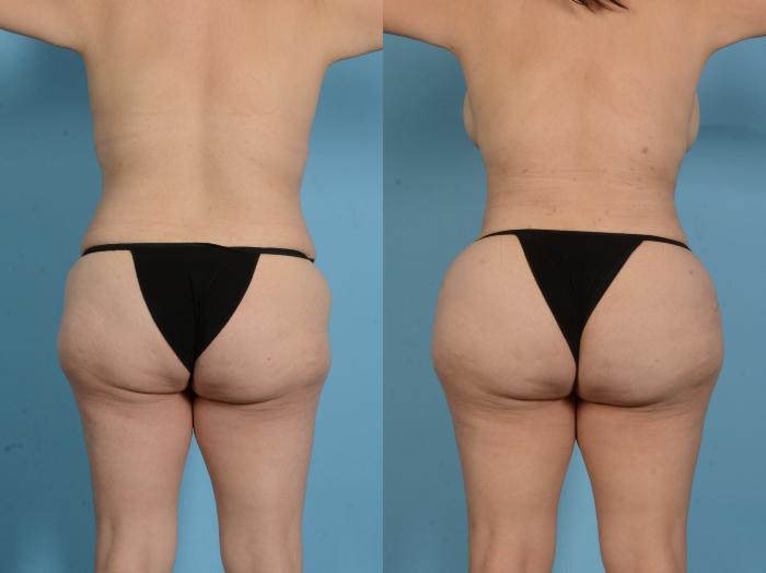 Before & After Brazilian Butt Lift Case 18138 Back View in Houston, TX