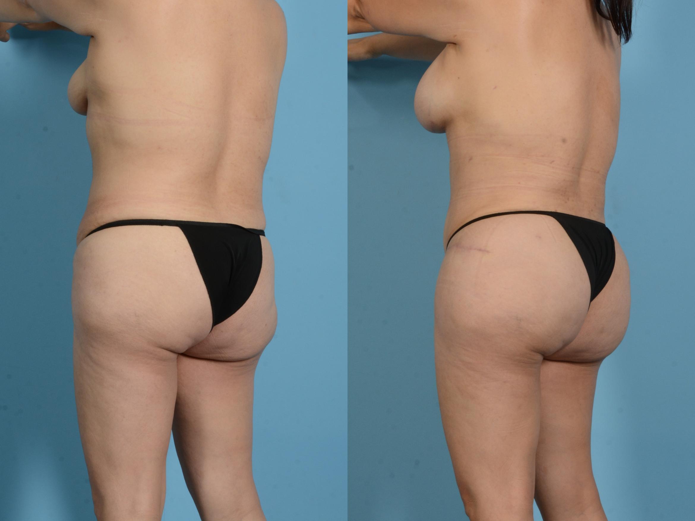 Before & After Brazilian Butt Lift Case 18138 Left Oblique View in Houston, TX
