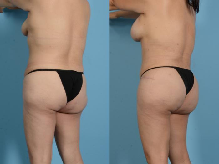 Before & After Brazilian Butt Lift Case 18138 Left Oblique View in Houston, TX