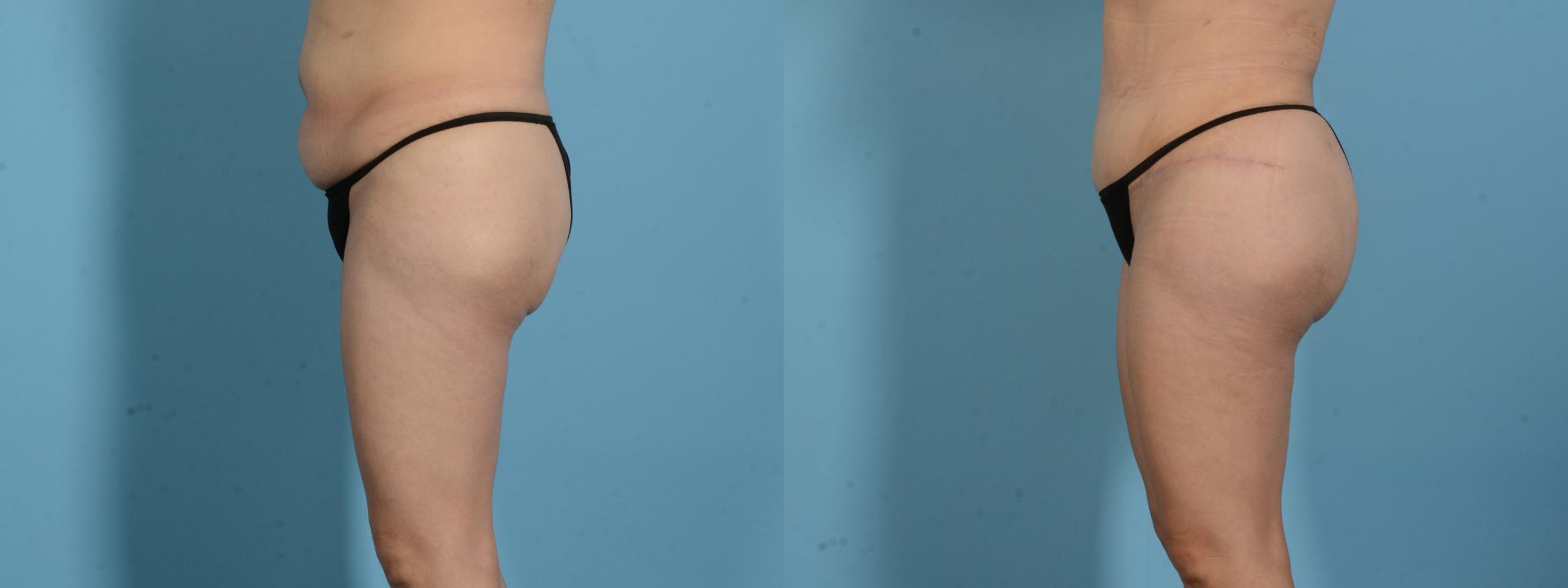 Before & After Brazilian Butt Lift Case 18138 Left Side View in Houston, TX