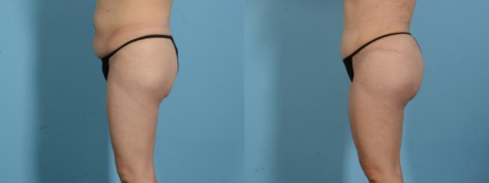 Before & After Brazilian Butt Lift Case 18138 Left Side View in Houston, TX