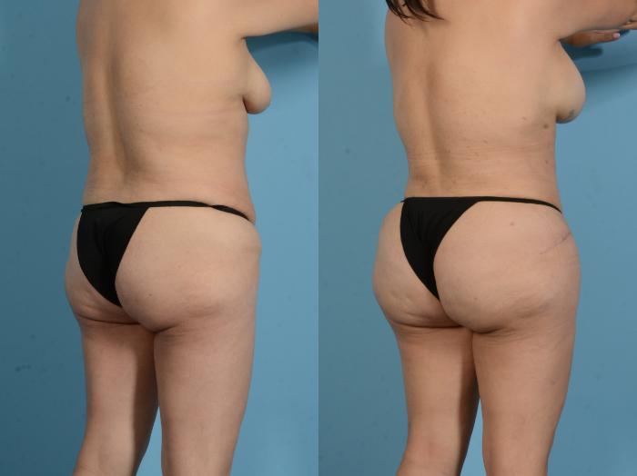 Before & After Brazilian Butt Lift Case 18138 Right Oblique View in Houston, TX