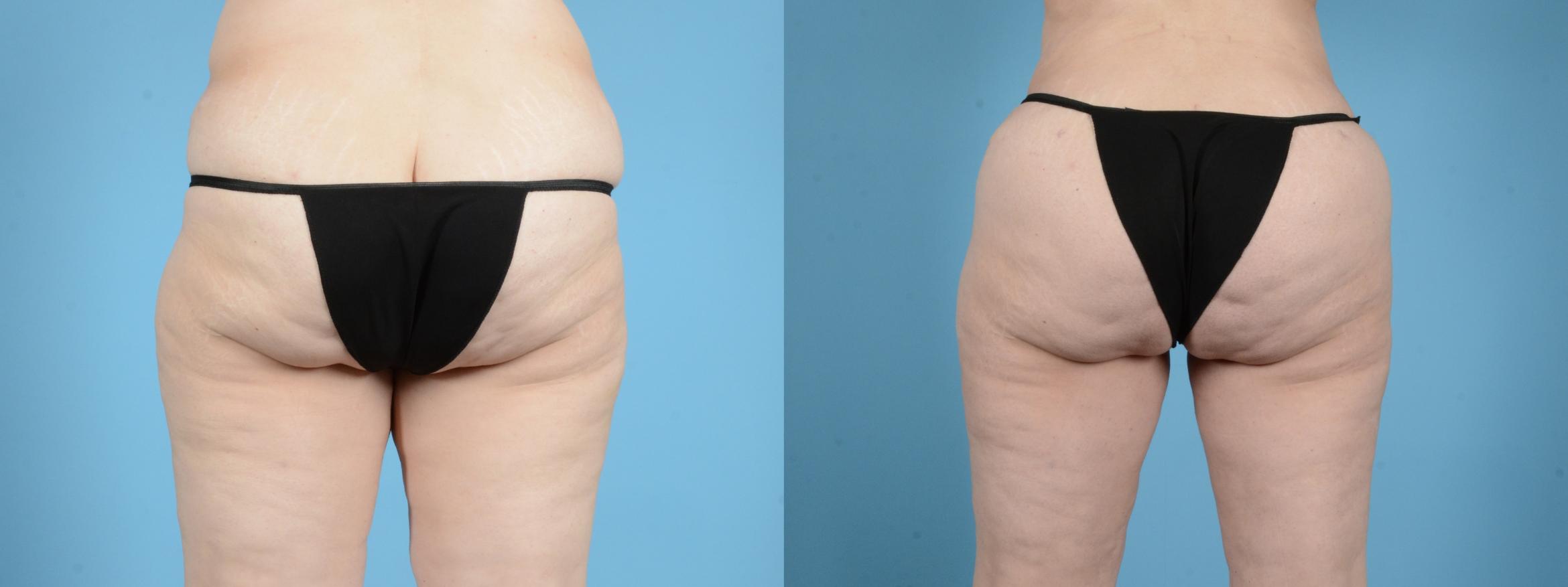 Before & After Brazilian Butt Lift Case 18142 Back View in Houston, TX
