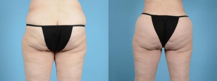 Before & After Brazilian Butt Lift Case 18142 Back View in Houston, TX