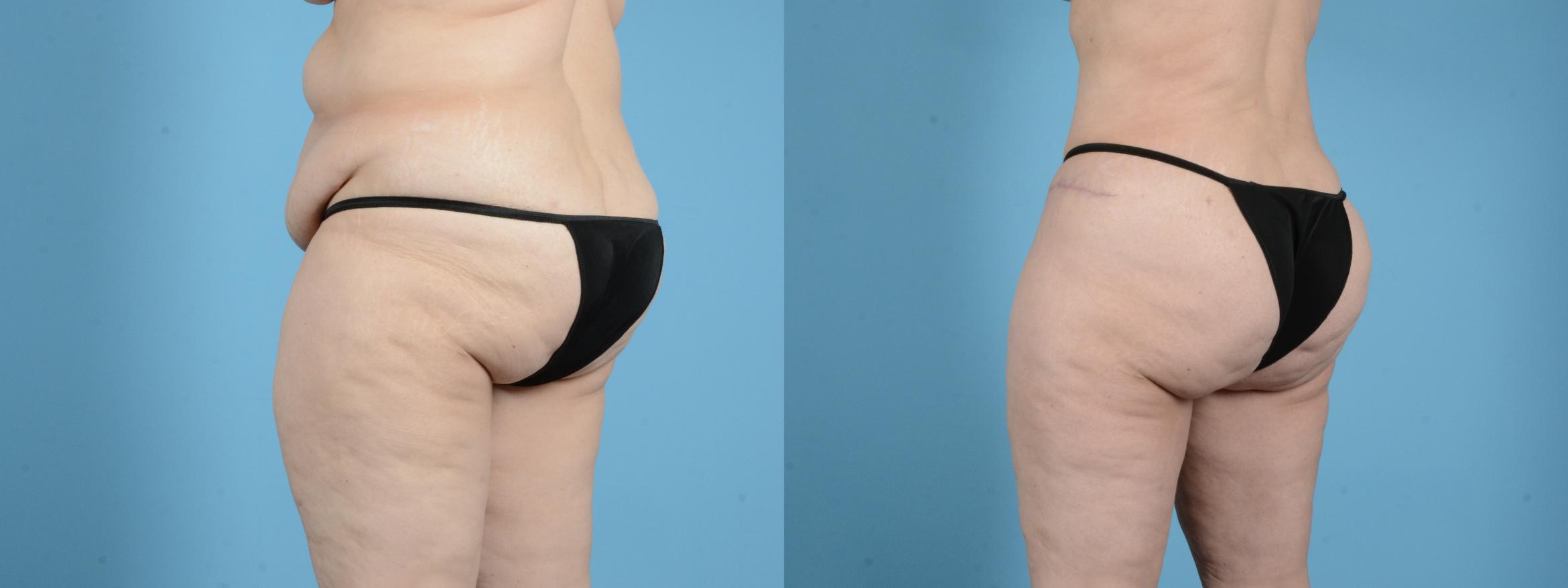 Before & After Brazilian Butt Lift Case 18142 Left Oblique View in Houston, TX