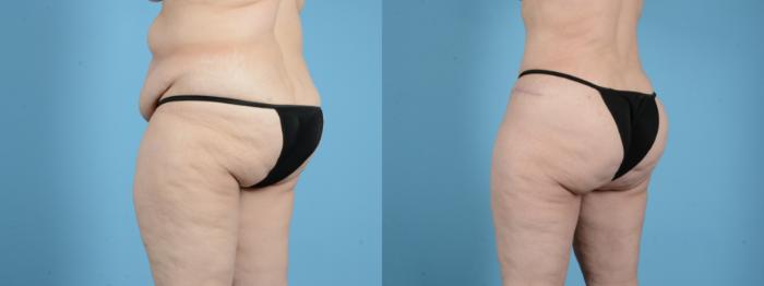 Before & After Brazilian Butt Lift Case 18142 Left Oblique View in Houston, TX
