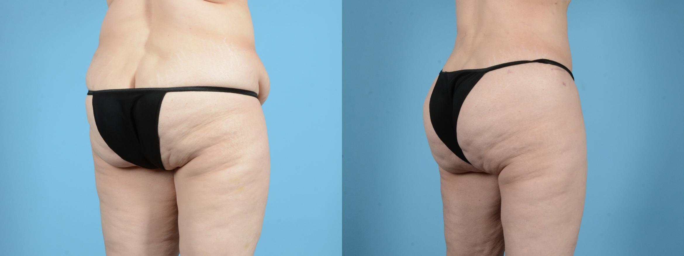 Before & After Brazilian Butt Lift Case 18142 Right Oblique View in Houston, TX