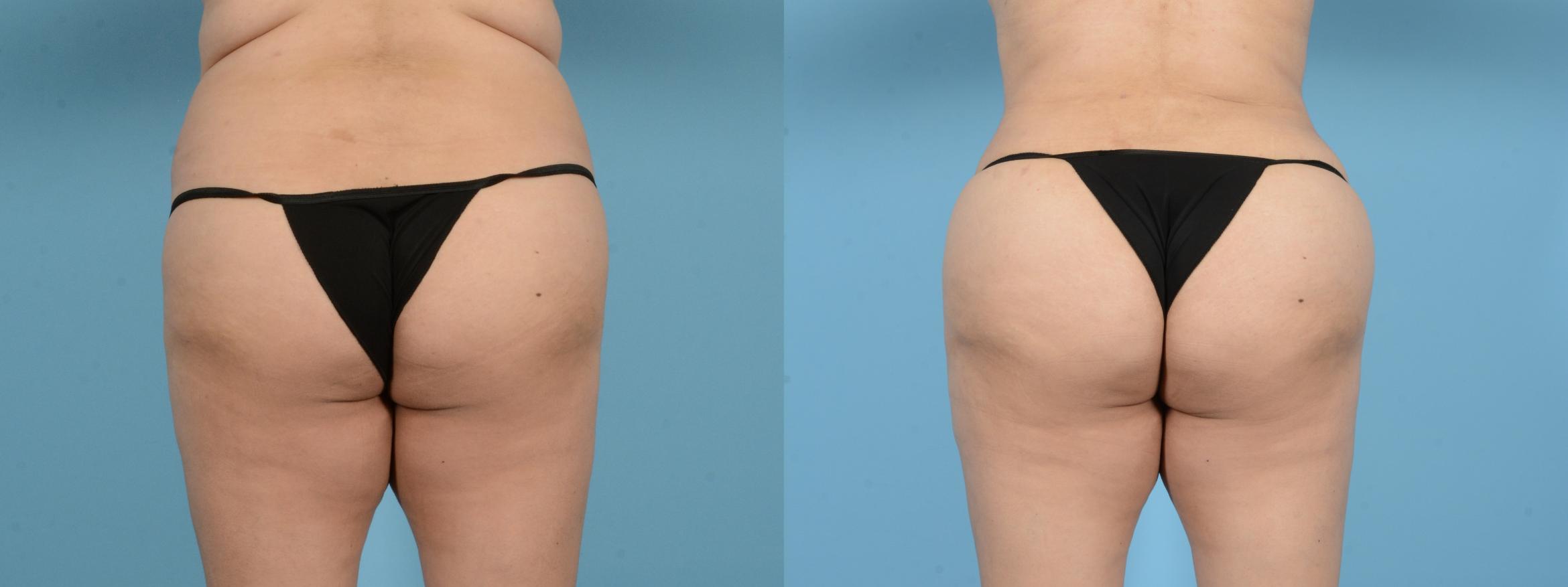 Before & After Brazilian Butt Lift Case 18143 Back View in Houston, TX