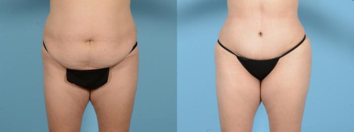 Before & After Brazilian Butt Lift Case 18143 Front View in Houston, TX