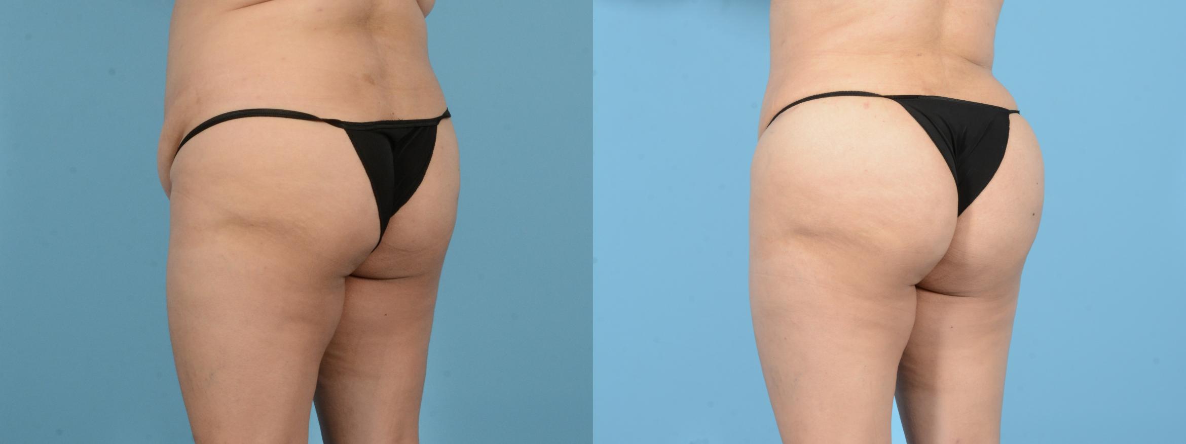 Before & After Brazilian Butt Lift Case 18143 Left Oblique View in Houston, TX