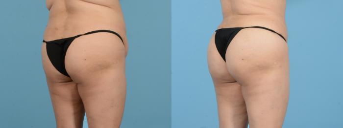 Before & After Brazilian Butt Lift Case 18143 Right Oblique View in Houston, TX