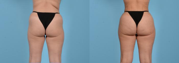 Before & After Brazilian Butt Lift Case 18145 Back View in Houston, TX
