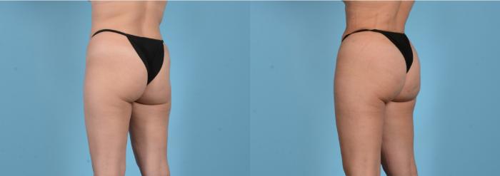 Before & After Brazilian Butt Lift Case 18145 Left Oblique View in Houston, TX