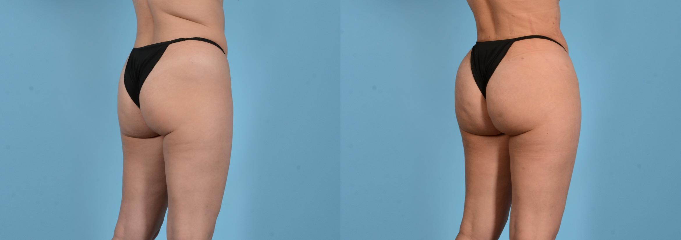 Before & After Brazilian Butt Lift Case 18145 Right Oblique View in Houston, TX