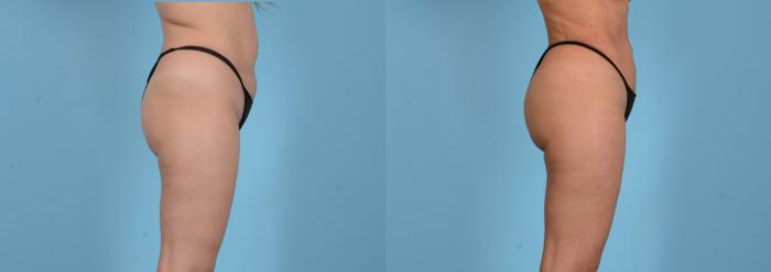 Before & After Brazilian Butt Lift Case 18145 Right Side View in Houston, TX