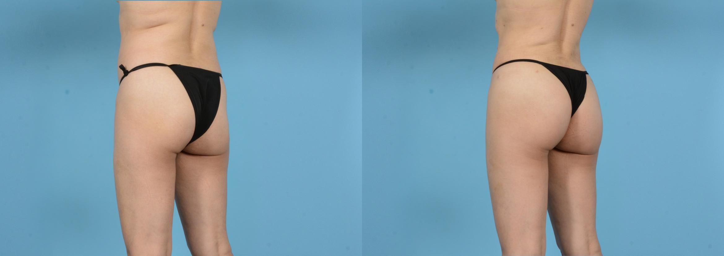 Before & After Brazilian Butt Lift Case 18146 Left Oblique View in Houston, TX