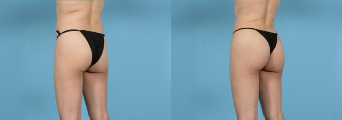 Before & After Brazilian Butt Lift Case 18146 Left Oblique View in Houston, TX