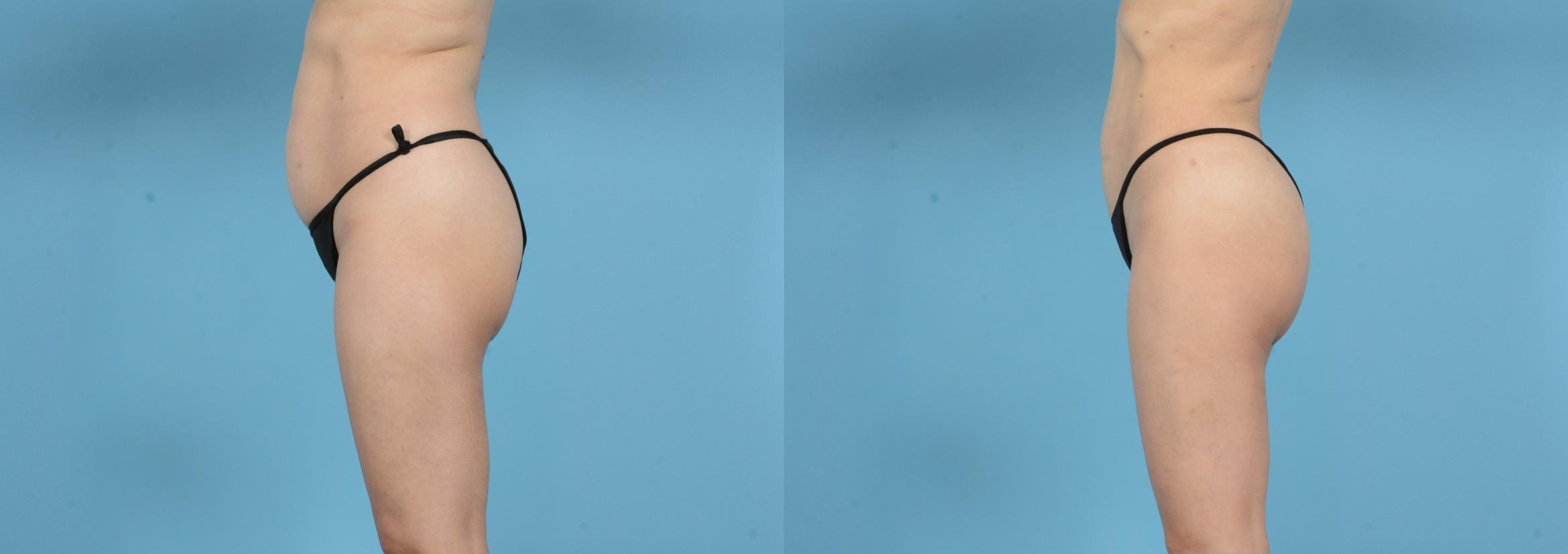 Before & After Brazilian Butt Lift Case 18146 Left Side View in Houston, TX