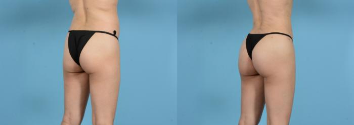 Before & After Brazilian Butt Lift Case 18146 Right Oblique View in Houston, TX