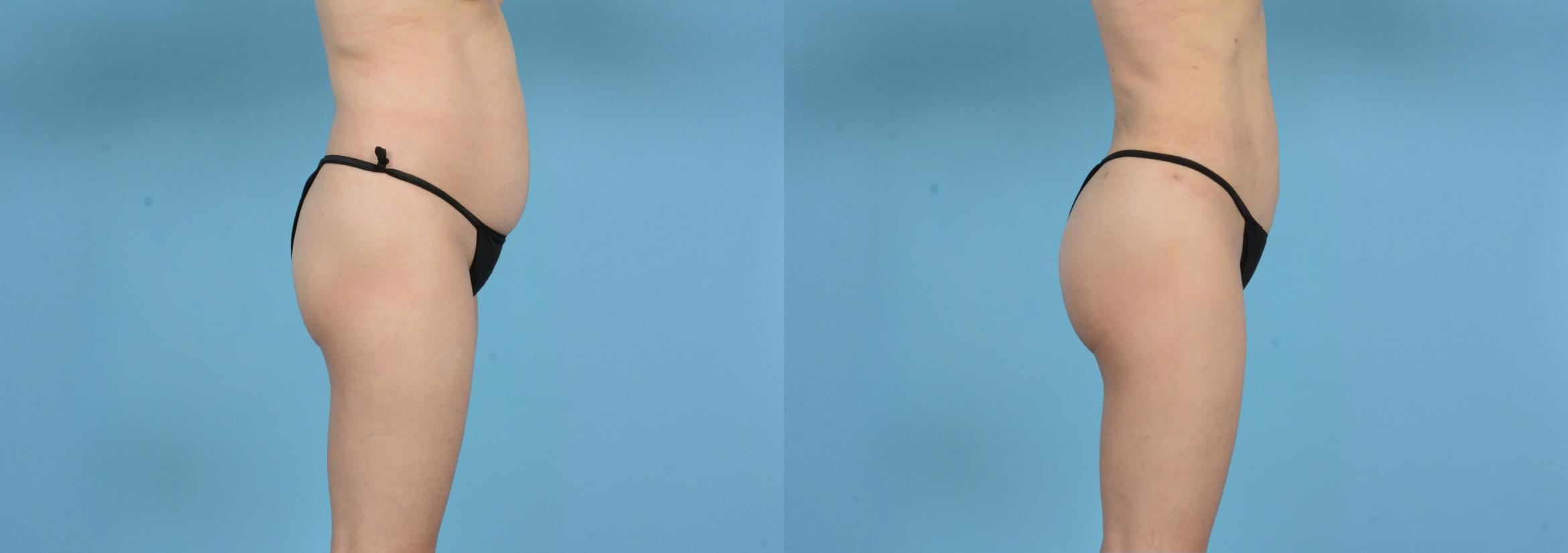 Before & After Brazilian Butt Lift Case 18146 Right Side View in Houston, TX