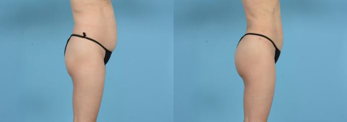 Before & After Brazilian Butt Lift Case 18146 Right Side View in Houston, TX