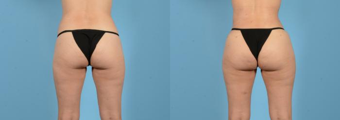 Before & After Brazilian Butt Lift Case 18148 Back View in Houston, TX
