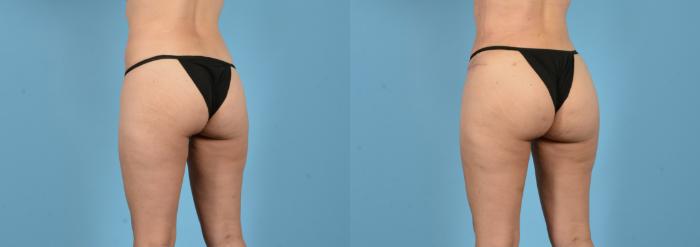 Before & After Brazilian Butt Lift Case 18148 Left Oblique View in Houston, TX