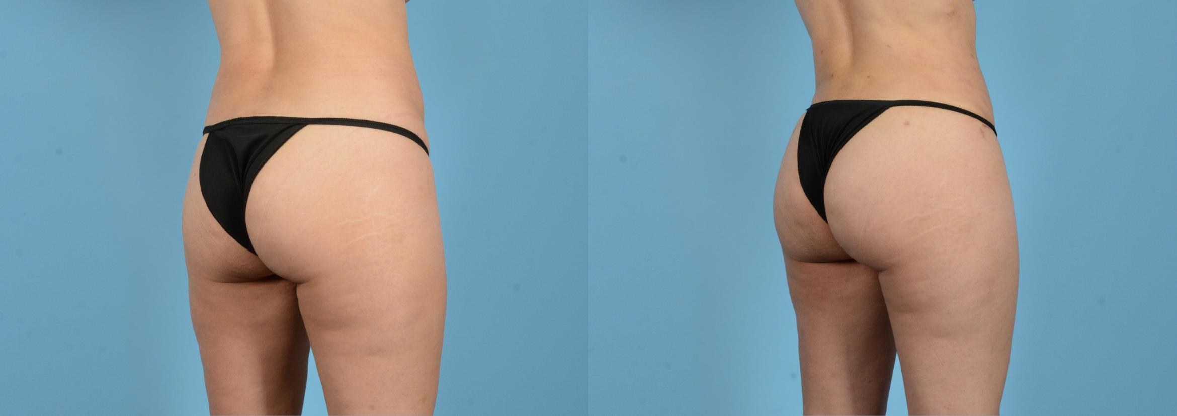 Before & After Brazilian Butt Lift Case 18148 Right Oblique View in Houston, TX