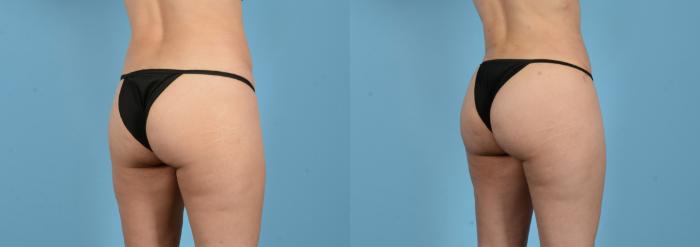 Before & After Brazilian Butt Lift Case 18148 Right Oblique View in Houston, TX