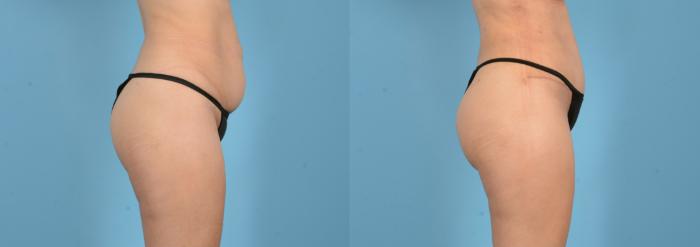 Before & After Brazilian Butt Lift Case 18148 Right Side View in Houston, TX